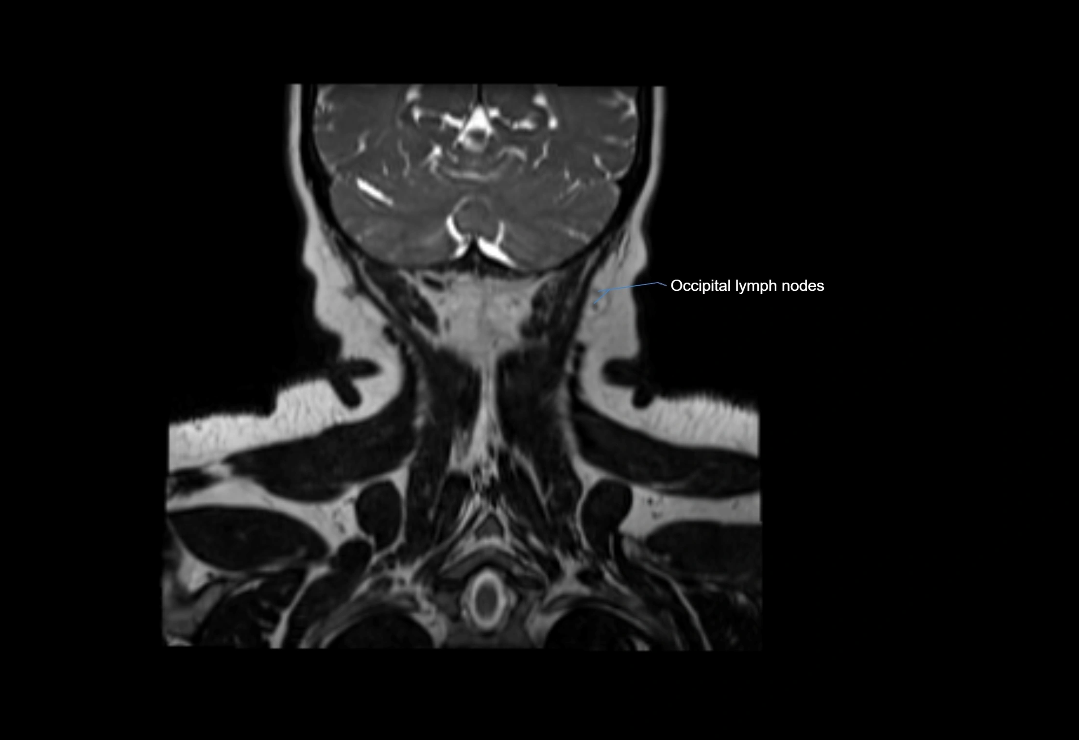 Neck coronal lymph node cross sectional MRI anatomy 3T MRI  image-img-00001-00010.webp
